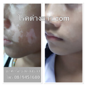 vitiligo oil review before and after