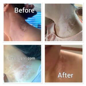 vitiligo oil review before and after
