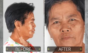 vitiligo oil review before and after