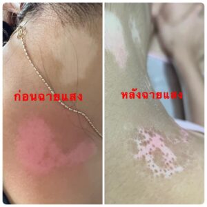vitiligo oil review before and after