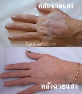 vitiligo oil review before and after
