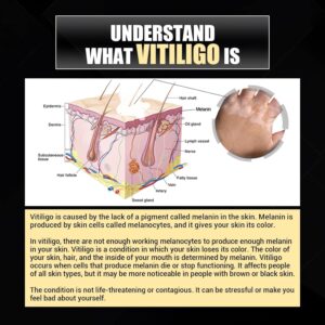 รักษาด่างขาว