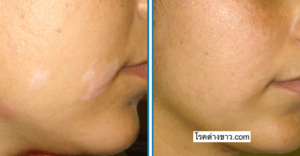 vitiligo oil review before and after