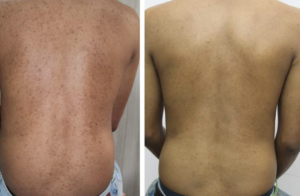 vitiligo oil review before and after