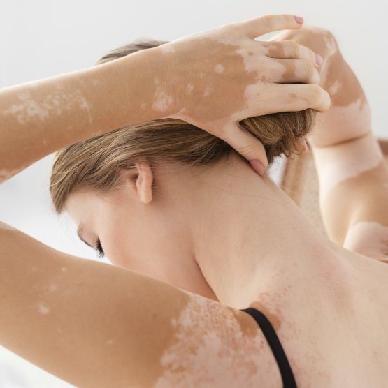 vitiligo skin