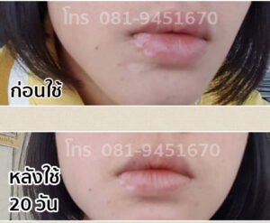 vitiligo oil review before and after