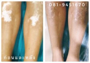 vitiligo oil review before and after