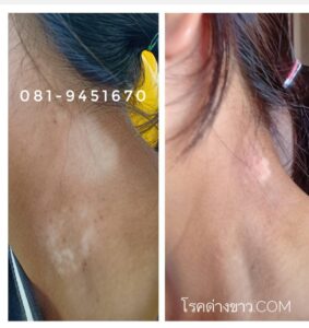 vitiligo oil review before and after