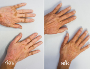 vitiligo oil review before and after