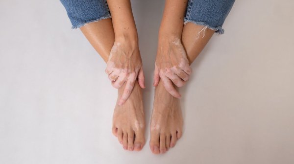 โรคด่างขาวที่เท้า