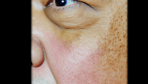 Read more about the article ทุกสิ่งที่คุณควรรู้เกี่ยวกับยาทาด่างขาวและโรคด่างขาว