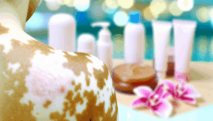 Read more about the article วิธีรักษาด่างขาว