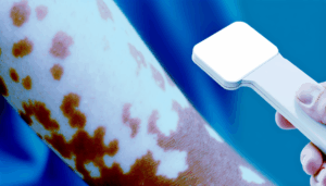 Read more about the article ยาทาด่างขาว วิธีและการรักษา