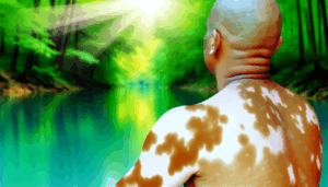 Read more about the article แนวทางการรักษาด่างขาวและการดูแลผู้ป่วย