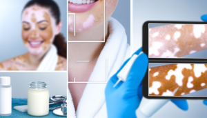 Read more about the article วิธีรักษาด่างขาว