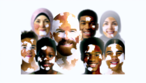 Read more about the article ความรู้เกี่ยวกับด่างขาวและการรักษาที่มีประสิทธิภาพ