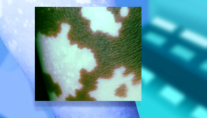 Read more about the article ด่างขาว: เข้าใจโรคด่างขาวและการรักษา