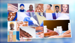 Read more about the article การรักษาด่างขาว: วิธีการและแนวทางที่คุณควรรู้