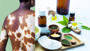 Read more about the article รักษาด่างขาว ด้วยสมุนไพรและยาทา