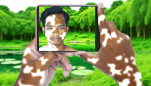 Read more about the article แนวทางการรักษาโรคด่างขาว