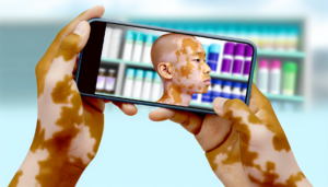 Read more about the article ทำความรู้จักกับด่างขาวและวิธีการรักษาที่มีประสิทธิภาพ