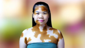 Read more about the article โรคด่างขาว: อาการ สาเหตุ และวิธีรักษา